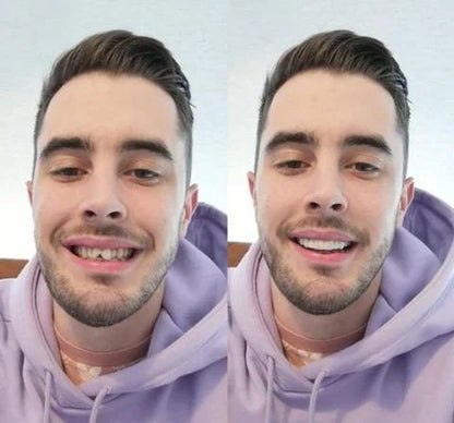 CARILLAS DENTALES SNAPON SMILE